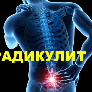Лечение радикулит