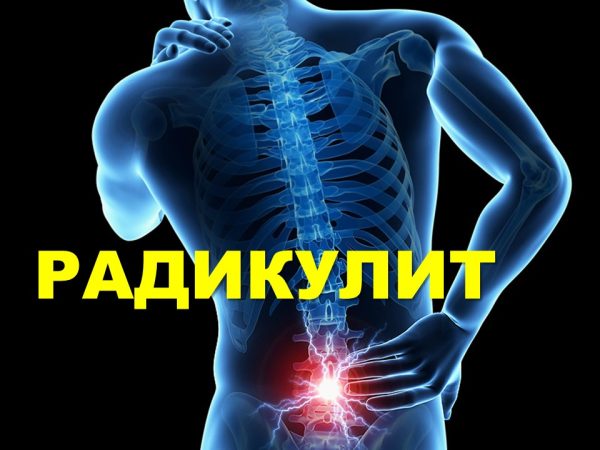Лечение радикулит