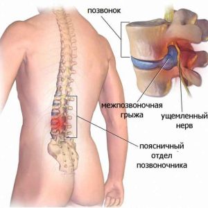 Лечение межпозвоночная грыжа