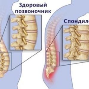 Лечение cпондилёза