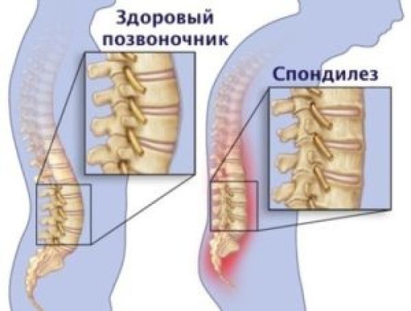 Лечение cпондилёза